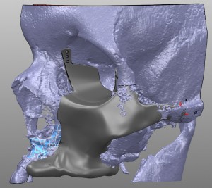 Restoration_Zygoma_orbit